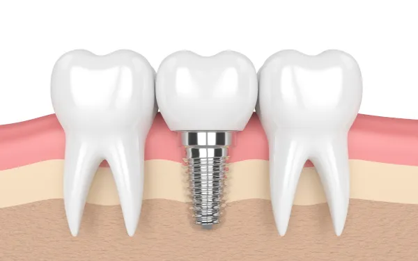 Dental İmplantlar